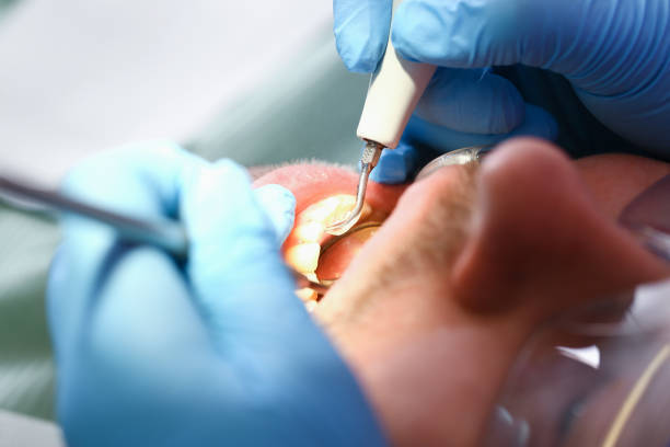 Best Emergency Wisdom Teeth Removal in Batavia, OH