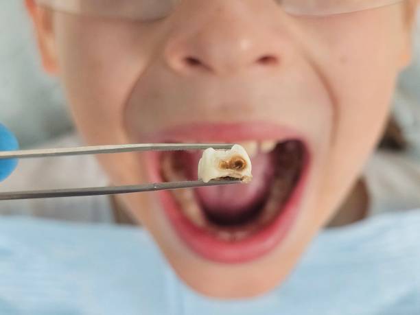 Best Emergency Treatment for Dental Infections or Abscesses in Batavia, OH